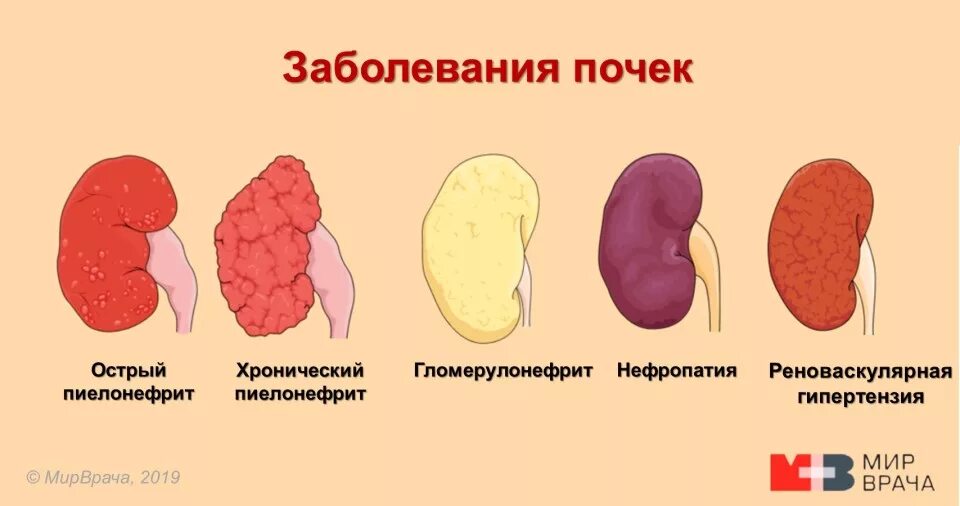 Воспаление почек заболевание. Патология почки. Пиелонефрит. Острый нефрит пиелонефрит. Острый пиелонефрит симптомы. Пиелонефрит это хроническое заболевание почек.