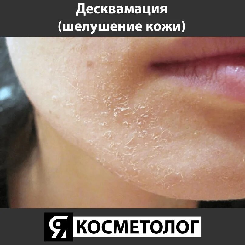 Шелушение кожи какие витамины