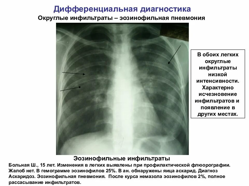 Стадия инфильтрации легких. Аскаридоз рентген легких синдром леффлера. эозинофильные инфильтраты в легких. эозинофильный легочный инфильтрат рентген. округлый инфильтрат туберкулез.