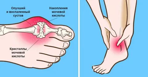 Какое воспаление при подагре