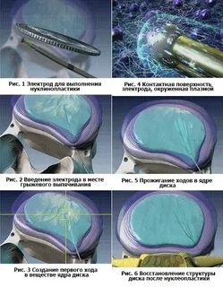Нуклеопластика межпозвонкового диска