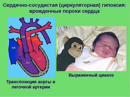 Врожденный сосудистый порок
