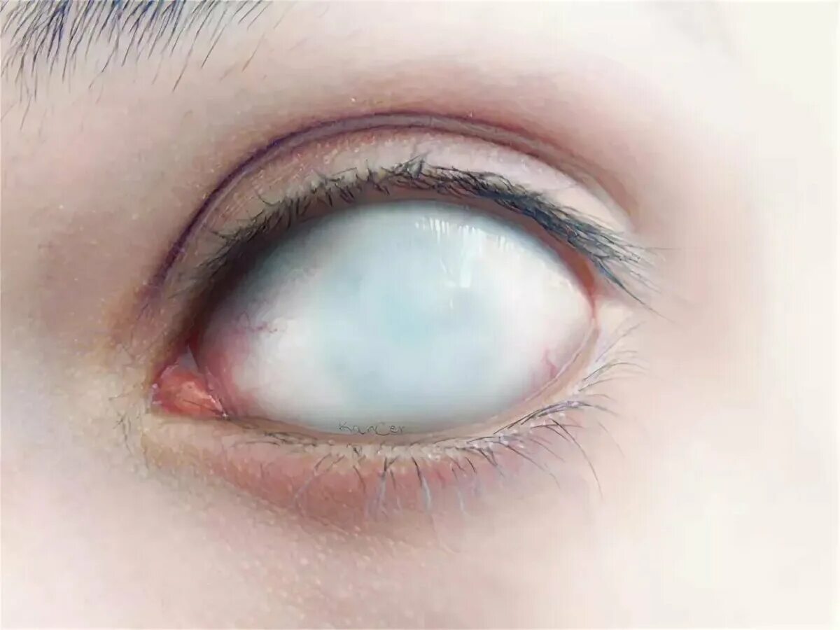 Склеральные линзы кератоконус. Тин глаз