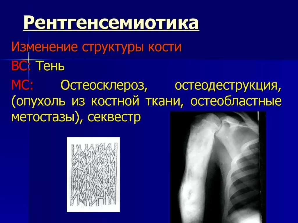 Остеосклероз кости рентген. Лучевые заболевания костей. Деструкция кости и остеосклероз. Остеобластные изменения костей. Изменение структуры кости