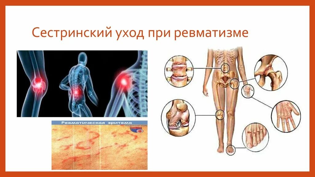 Помощь при ревматизме. Сестринский уход при ревматизме. ревматизм сестринский уход. сестринский процесс при ревматизме у детей. плакат на тему ревматизм.