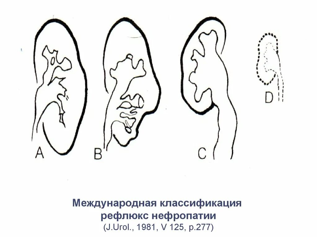 Классификация рефлюкса. Рефлюкс-нефропатия у детей. Рефлюкс нефропатия классификация. Рефлюкс нефропатия клиника. Рефлюкс-нефропатия у детей классификация.