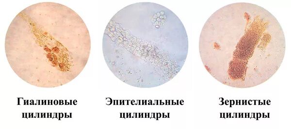 Повышенные цилиндры в моче. Моча гиалиновые, зернистые, эпителиальные цилиндры. Гиалиновые и зернистые цилиндры. Зернистые и восковидные цилиндры. Гиалиновый цилиндр в осадке мочи.