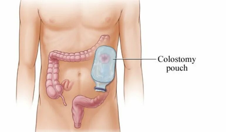 Как восстановить кишечник после операции. Колостома -Стома толстой кишки.. Лапароскопическая колостомия. Колостома топографическая анатомия. Колостома прямой кишки.