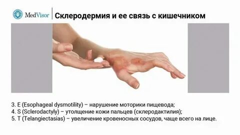 Что такое склеродермия простыми словами