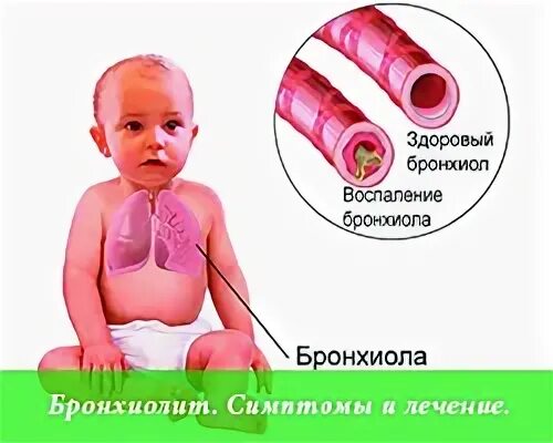 Бронхиолит причины. Бронхиолит причины
