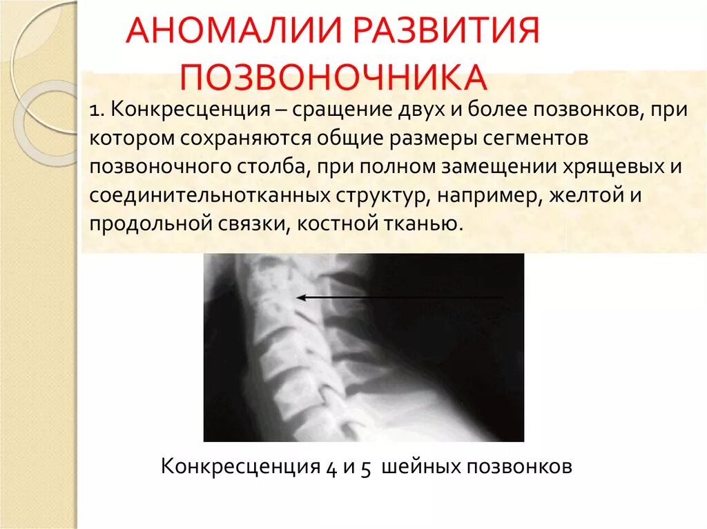 Аномалии развития нерва. Аномалии развития шейного отдела позвоночника рентген. Врожденная аномалия развития позвоночника. Дефекты позвонков врожденные. Аномалии развития с2 позвонка.