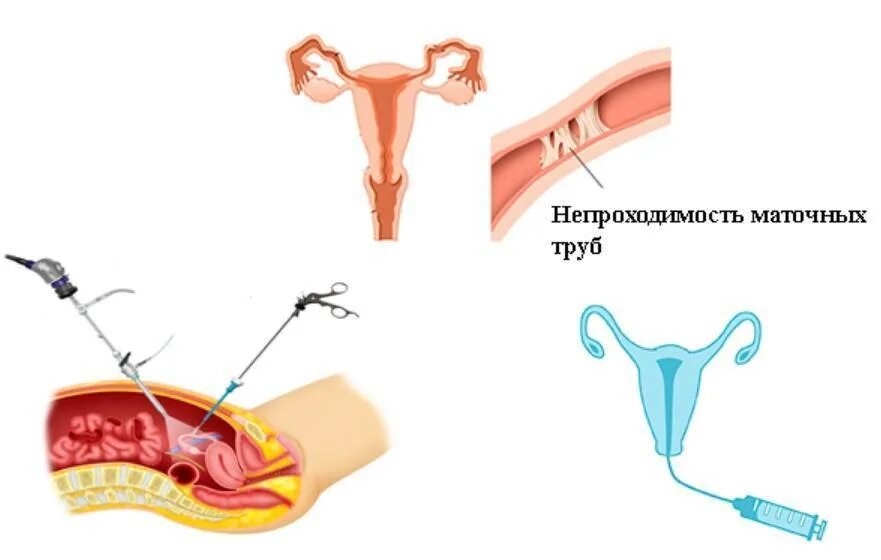 Операция проходимость труб. Лапароскопия непроходимость труб. ГСГ обследование маточных труб. Методы проходимости маточных труб. Процедура ГСГ маточных труб.