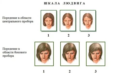 Виды выпадения