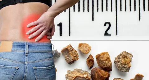 Як розчинити камені в нирках: народні засоби та ліки