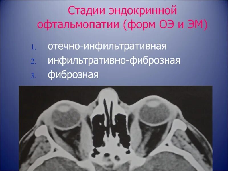 Пульс терапия при эндокринной офтальмопатии. Эндокринная офтальмопатия кт орбит. эндокринная офтальмопатия мрт. эндокринная офтальмопатия кт. кт орбит при эндокринной офтальмопатии.