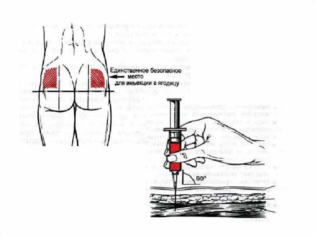 Укола в ягодицу кровь почему. Схема внутримышечных инъекций масляных растворов. Внутримышечной инъекции место введения инъекций. Техника внутримышечной инъекции в ягодицу алгоритм. Внутримышечная инъекция алгоритм укол.