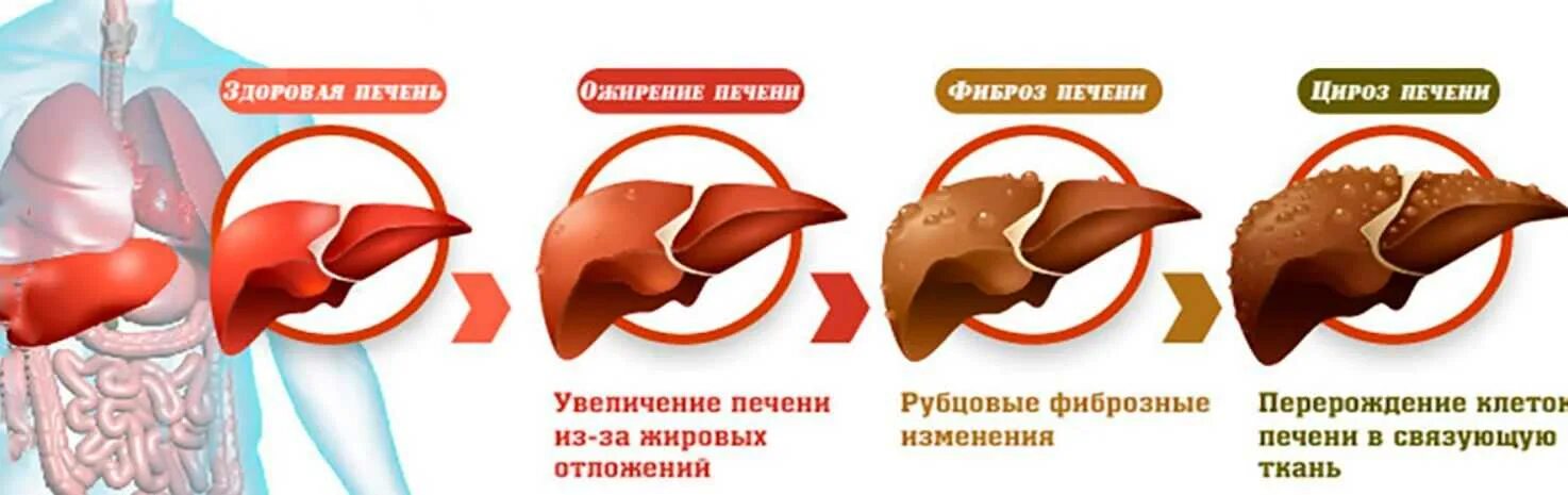 Алкогольная жировая болезнь