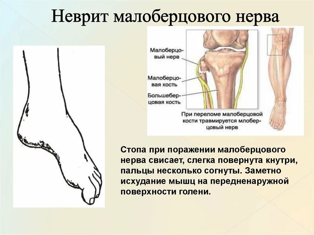 Поражение нервов нижних конечностей. Синдроме компрессии общего малоберцового нерва. Клинические проявления поражения малоберцового нерва. Симптомы поражения большеберцового и малоберцового нервов. Повреждение поверхностного малоберцового нерва.