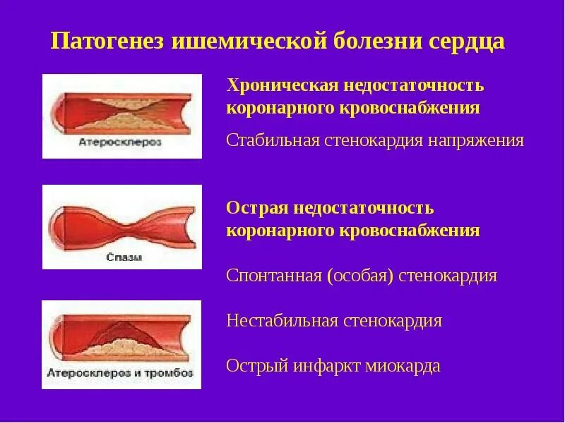 Ишемия атеросклероз