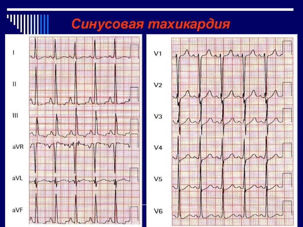 Синусовая тахикардия вертикальное. ЭКГ тахикардия синусовый ритм. ЭКГ критерии синусовой тахикардии. Кардиограмма при синусовой тахикардии. ЭКГ синусовая тахикардия пленка.