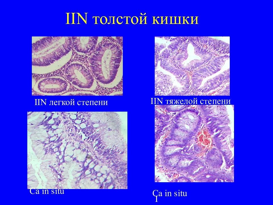 Аденома кишечника гистология. Тубуло-ворсинчатая аденома толстой кишки гистология. Ворсинчатая аденома гистология. Виллезная аденома толстой кишки гистология. Тубулярная аденома толстой кишки что