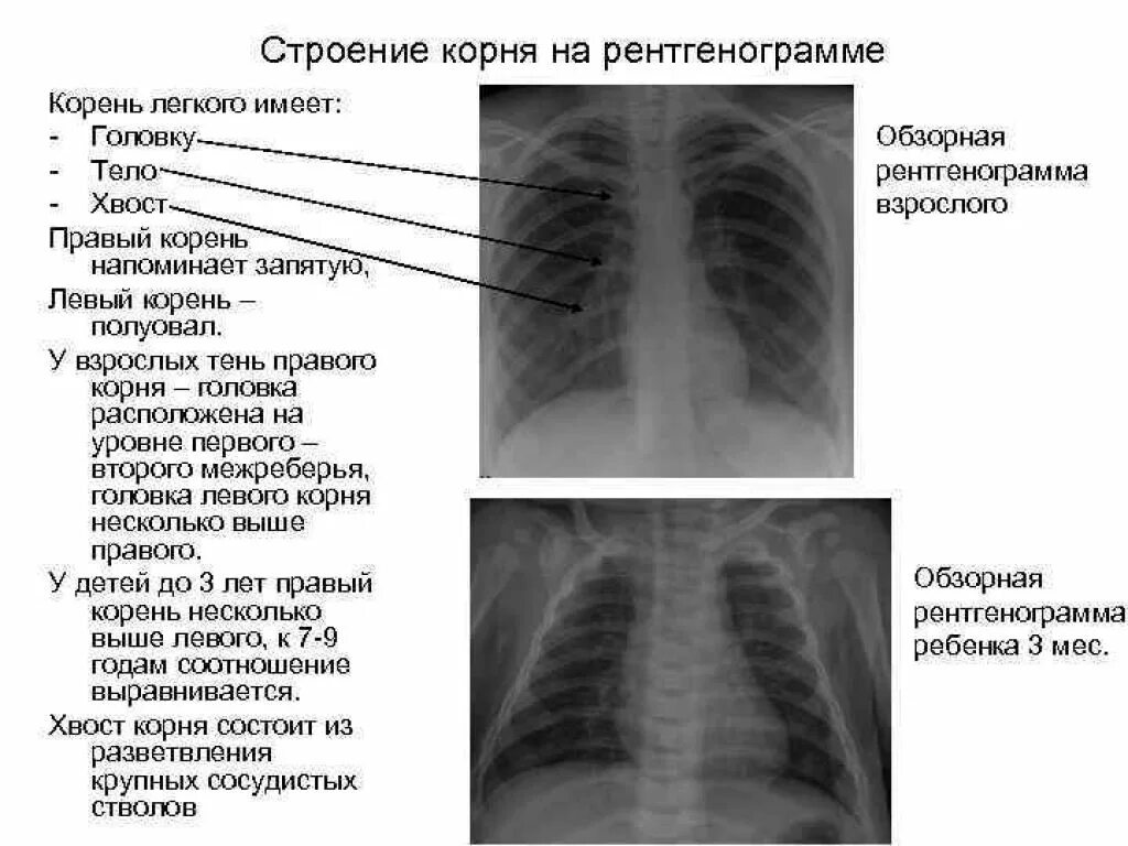 Увеличение корень легкого. Патология корня лёгкого на рентгенограмме. Структура корня легкого на рентгенограмме. Корень легкого на рентгенограмме в норме. Лучевая диагностика при патологии корня легкого.