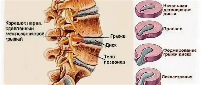 Грыжа позвоночника книга. Протрузия и грыжа в чем разница.