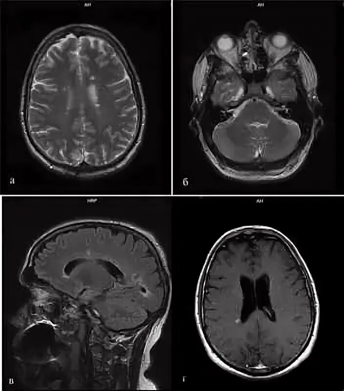 Мелкие очаги в головном мозге. Мрт рассеянный склероз очаги демиелинизации. Мрт головного мозга т1 т2 т2а. Рассеянный склероз на мрт головного мозга. Очаг демиелинизации в головном на т1.