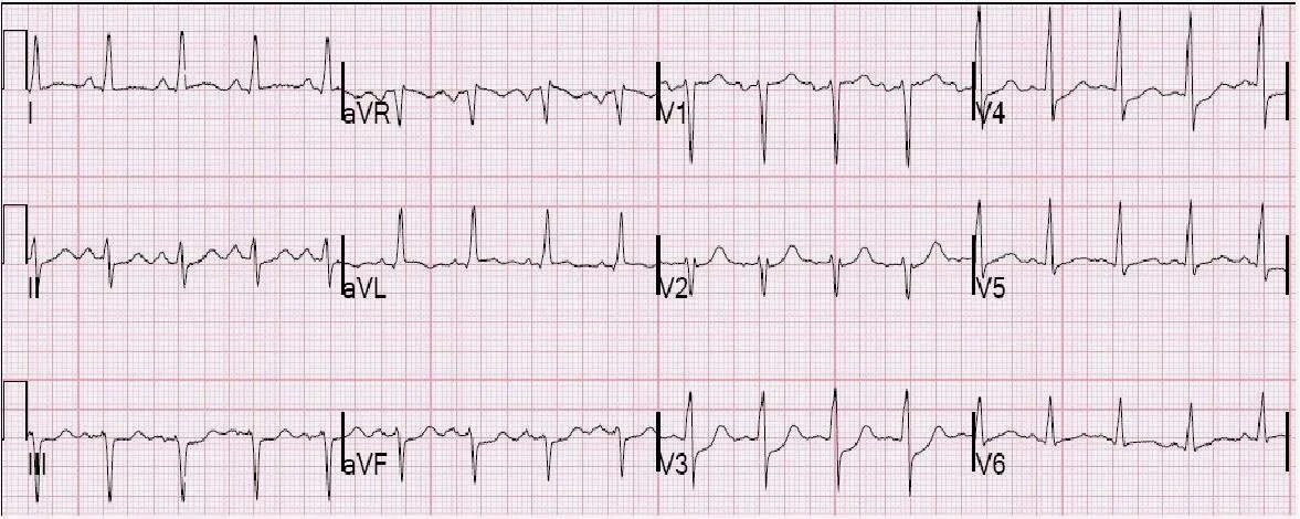 Депрессия сегмента st. Депрессия St v4-v6 ЭКГ. Элевация St 2,3, AVF. Элевация сегмента St в v1-v5. Депрессия сегмента St на ЭКГ.