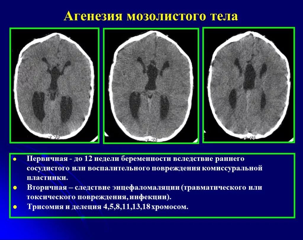 Аномалии развития желудочков головного мозга. Агенезия мозолистого тела мрт. Агенезия мозолистого тела на кт. Агнезия мозолистого тела. Агнезия мозолистого тела.