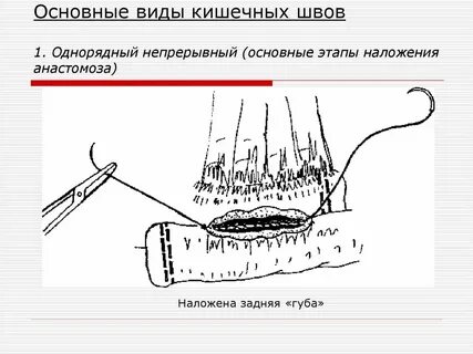 Кишечный шов