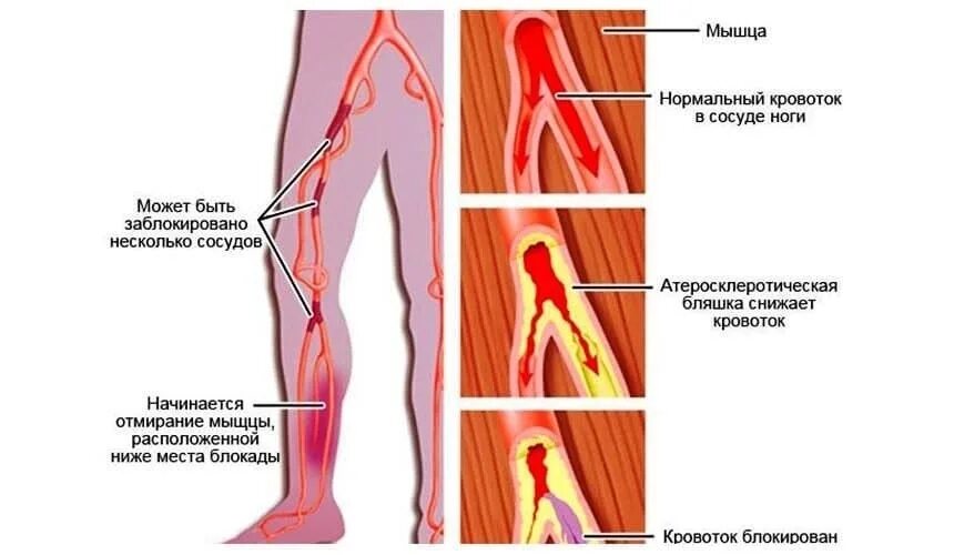 Нормальному кровообращению. Облитерирующий атеросклероз симптомы. Облитерирующий атеросклероз нижних конечностей. Облитерирующий атеросклероз артерий конечности. Атеросклероз артерий нижних конечностей факторы.