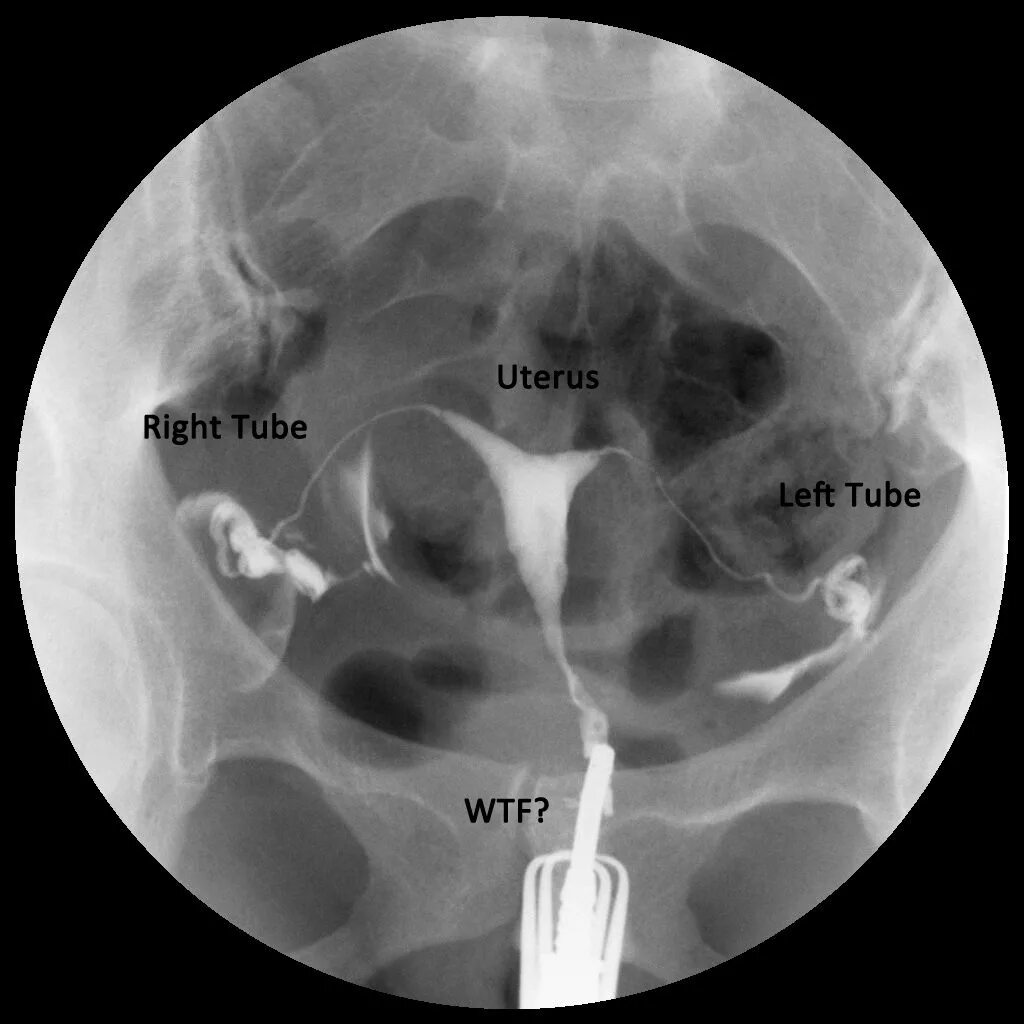 Эхо трубы. Гистеросальпингография (метросальпингография) МСГ. ГСГ рентген маточных труб. ГСГ проходимость маточных труб.