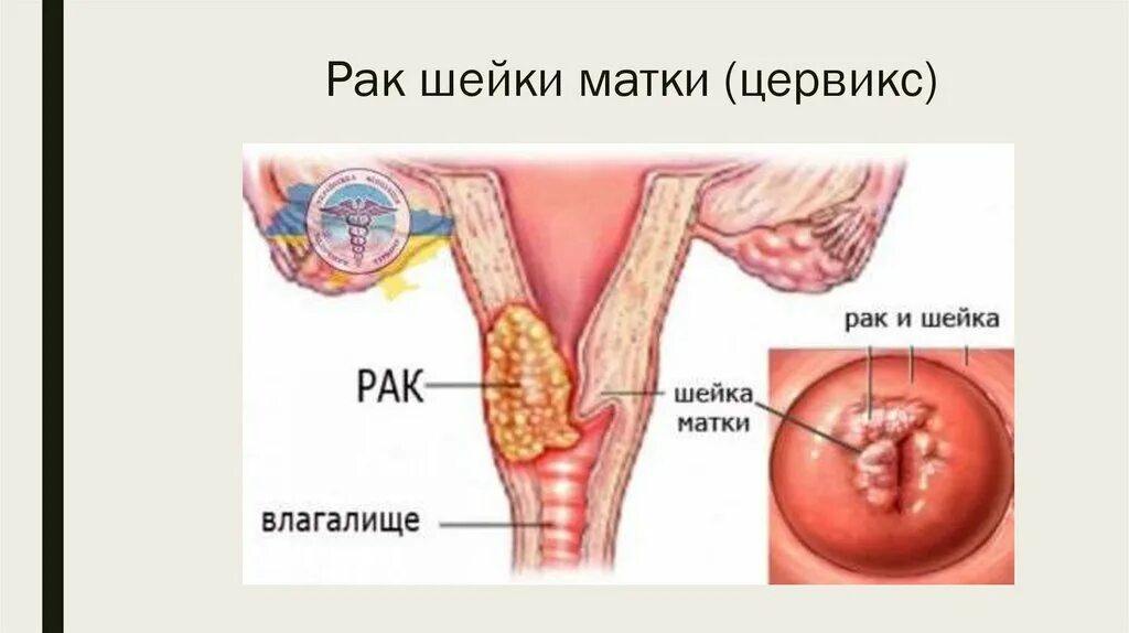 Раковая опухоль влагалища. Аденокарцинома влагалища. Опухоль женской шейки матки.