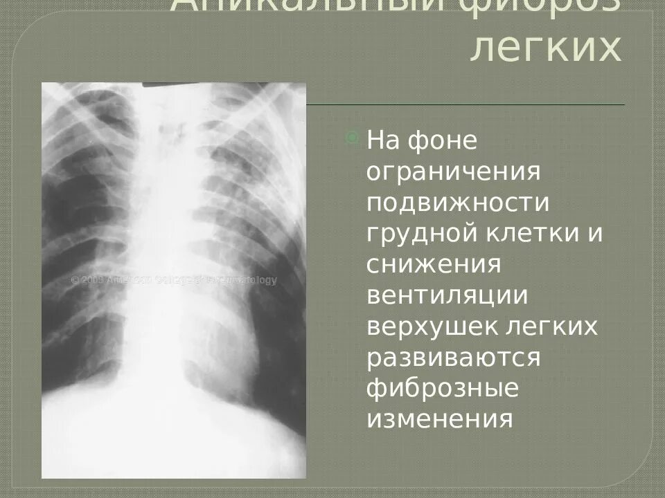 Плевральные наслоения. Апикальные отделы легких. Что означает изменения в легких