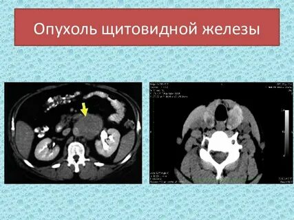 Объемное образование щитовидной железы