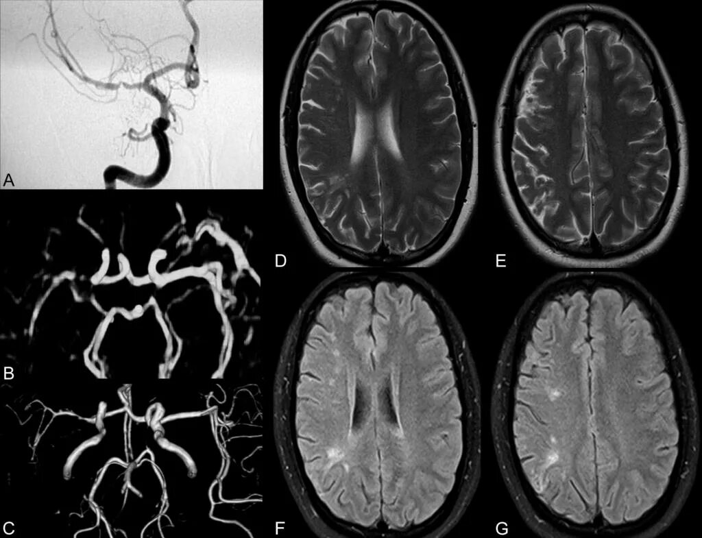 Магнитно-резонансная ангиография головного мозга. Магнитно-резонансная ангиография артерий головного мозга. Мрт головного мозга с ангиографией. Атеросклероз сосудов головного мозга ангиография.