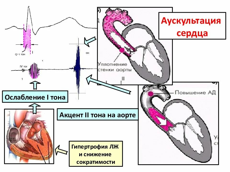 Акцент 2 тона на аорте схема. II тон на аорте ослаблен. Ослабление 1 тона сердца. Ослабление второго тона на аорте. Ослабленные тоны сердца