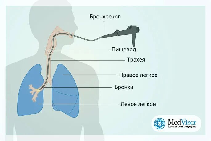Как берут биопсию из легких. Бронхоскопия строение бронхов. бронхоскопия и биопсия легких. бронхоскопия схема бронхов. бронхи схема бронхоскопия.