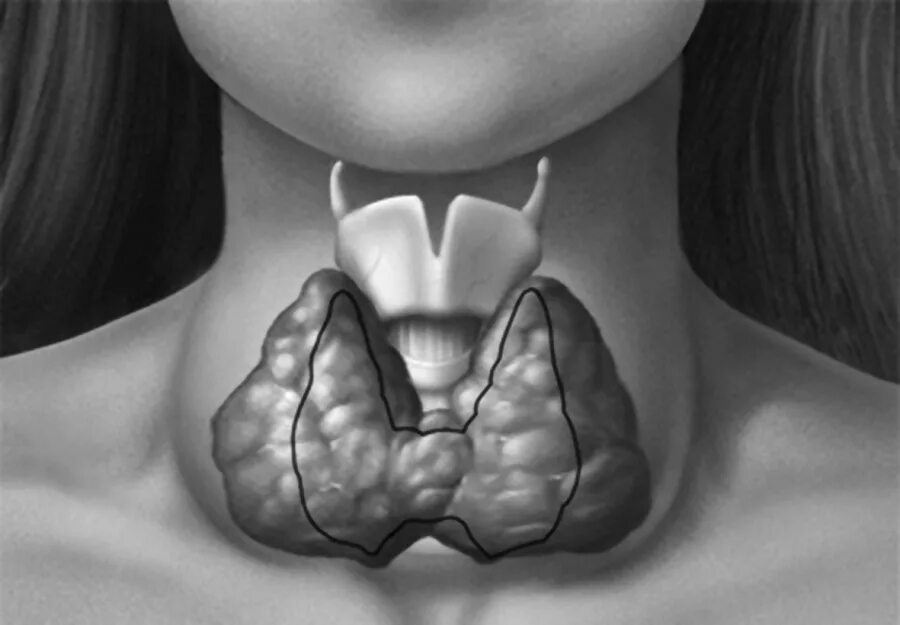 Асимметрия щитовидной железы. Зоб ахан