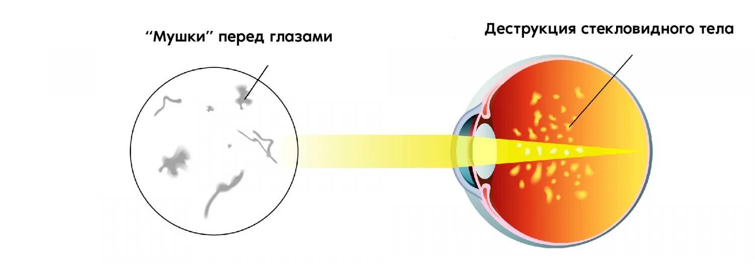 Деструкция стекловидного тела. Мушки в глазах деструкция стекловидного тела. Стекловидного тела деструкция тела. Деструкция в стекловидном теле глаза.