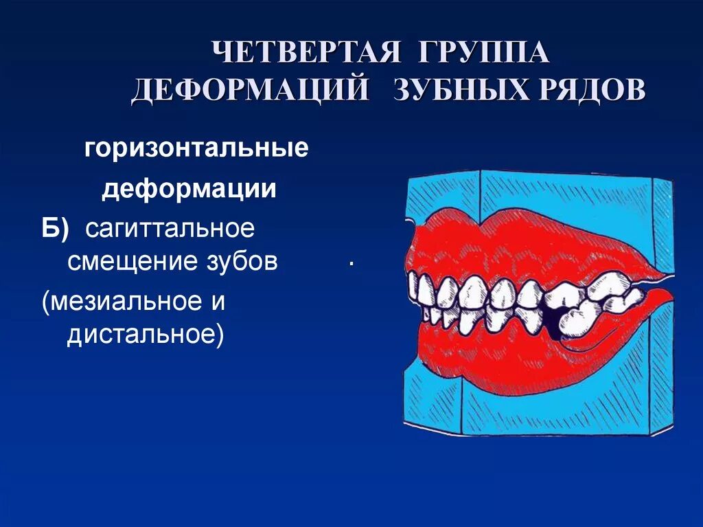 Классификация деформаций зубных рядов. Деформация зубов зубных рядов. деформация зубных рядов и прикуса.
