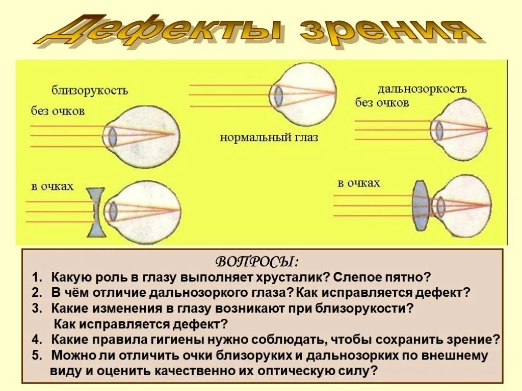 Глаз очки дальнозоркость и близорукость. Близорукость и дальнозоркость. Глаз. Очки. Близорукость и дальнозоркость. Очки при близорукости и дальнозоркости. Глаз при близорукости и дальнозоркости.