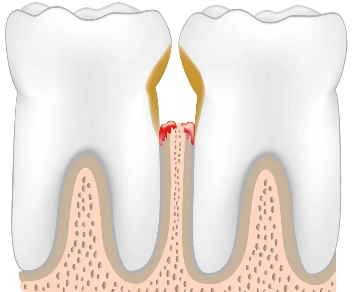 Почему открывают зуб. Периодонтальный пародонтит. Периодонтит и пародонтит. Папиллит, гингивит, пародонтит). Язвенно-некротический гингивит-пародонтит.