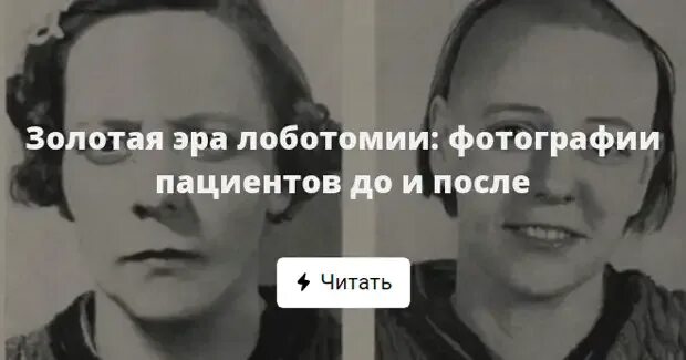 Пациенты после лоботомии. Лоботомия где