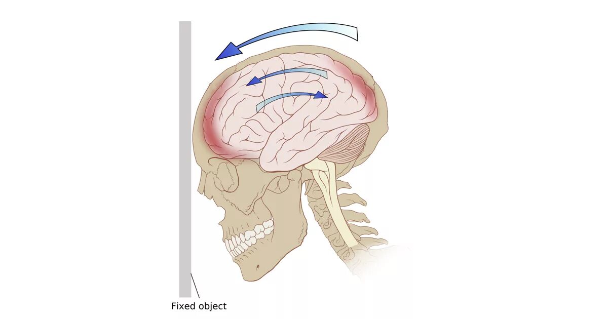 Повреждения головного мозга возникают. Черепно-мозговая травма. ЛФК при черепно-мозговой травме. Закрытые черепно мозговые травмы.