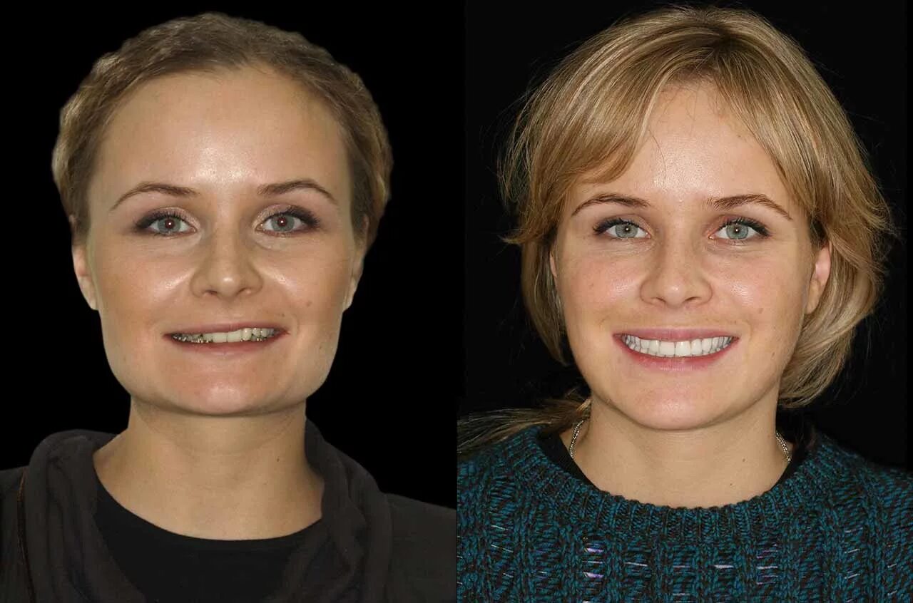 После 45 лет когда менять. Асимметрия лица. Асимметрия улыбки. Исправление асимметрии лица. Асимметрия лица до и после.