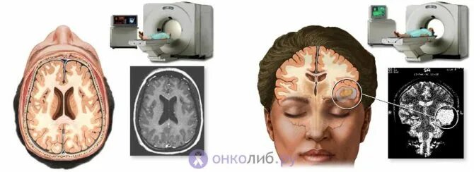 Мозг удален. Операция лучевая менингиома головного мозга. доброкачественная опухоль головного мозга операция. опухоль головного мозга операция вскрытие черепа. операция на головной опухоль.