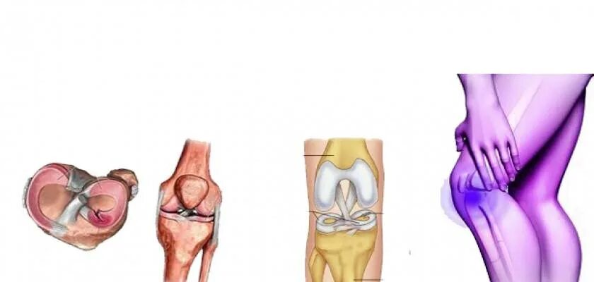 Болит ли мениск. Повреждение мениска коленного сустава. Разрыв мениска коленного сустава симптомы. Разрыв мениска коленного сустава 3 а. Контузия мениска коленного сустава.