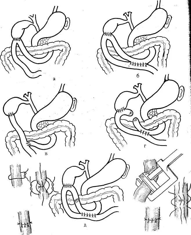 Билиодигестивный анастомоз. Холедохоеюнальный анастомоз. Брауновский анастомоз холецистоеюно. Схема операции гепатикоеюноанастомоз.